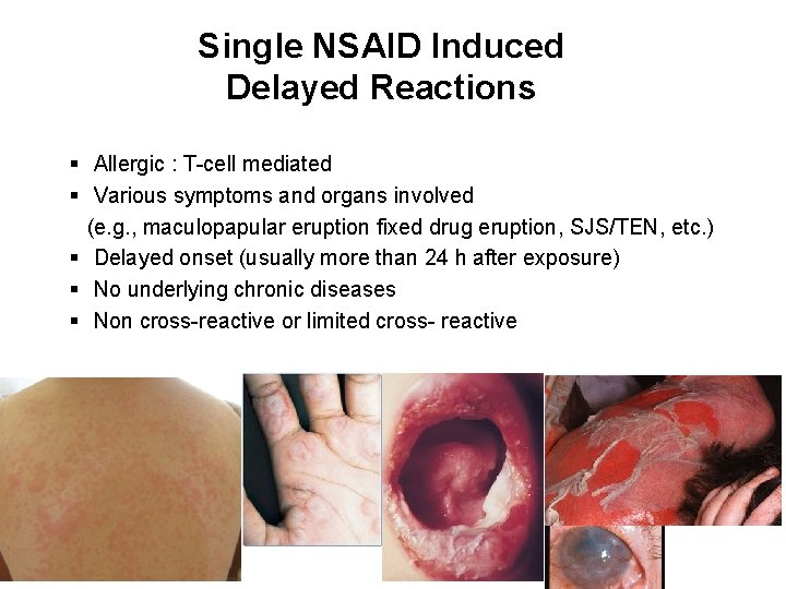 Single NSAID Induced Delayed Reactions § Allergic : T-cell mediated § Various symptoms and