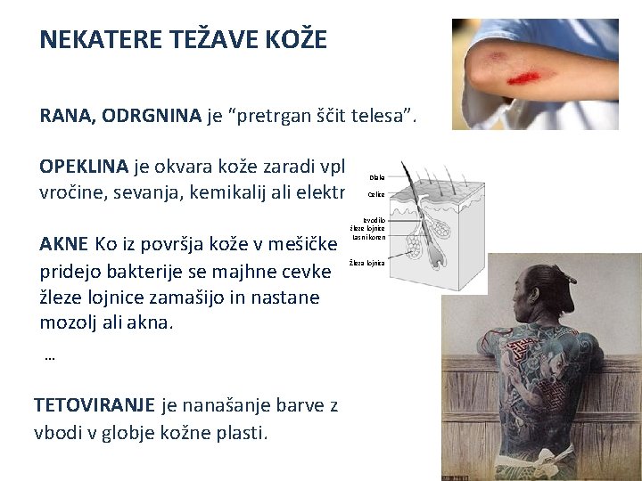 NEKATERE TEŽAVE KOŽE RANA, ODRGNINA je “pretrgan ščit telesa”. OPEKLINA je okvara kože zaradi