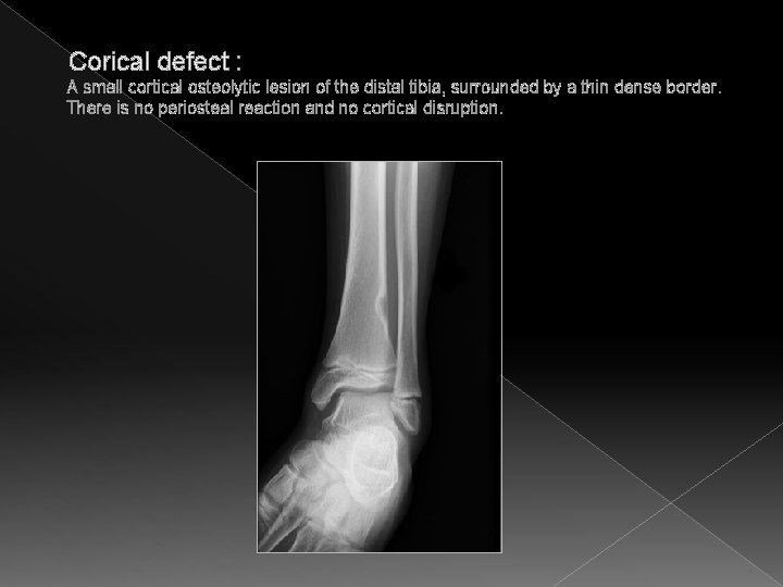  Corical defect : A small cortical osteolytic lesion of the distal tibia, surrounded