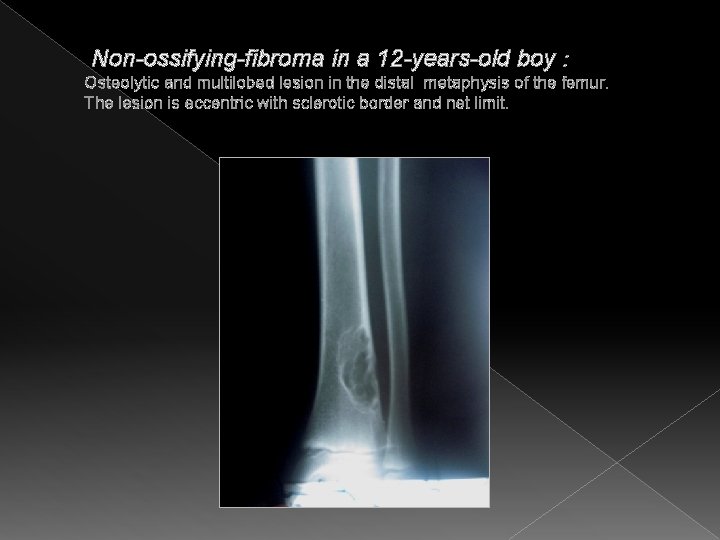 Non-ossifying-fibroma in a 12 -years-old boy : Osteolytic and multilobed lesion in the distal