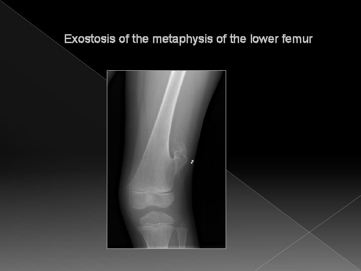 Exostosis of the metaphysis of the lower femur 