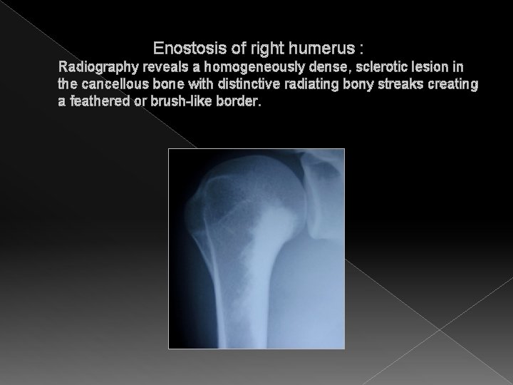  Enostosis of right humerus : Radiography reveals a homogeneously dense, sclerotic lesion in