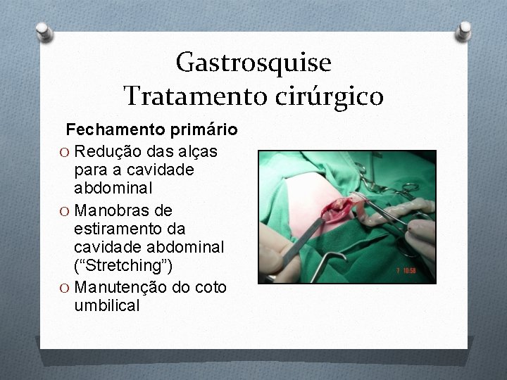Gastrosquise Tratamento cirúrgico Fechamento primário O Redução das alças para a cavidade abdominal O