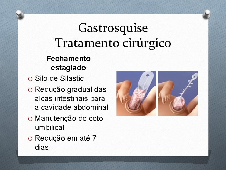 Gastrosquise Tratamento cirúrgico Fechamento estagiado O Silo de Silastic O Redução gradual das alças