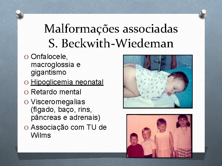 Malformações associadas S. Beckwith-Wiedeman O Onfalocele, macroglossia e gigantismo O Hipoglicemia neonatal O Retardo