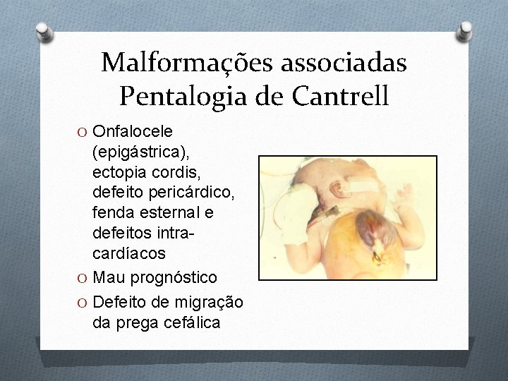 Malformações associadas Pentalogia de Cantrell O Onfalocele (epigástrica), ectopia cordis, defeito pericárdico, fenda esternal