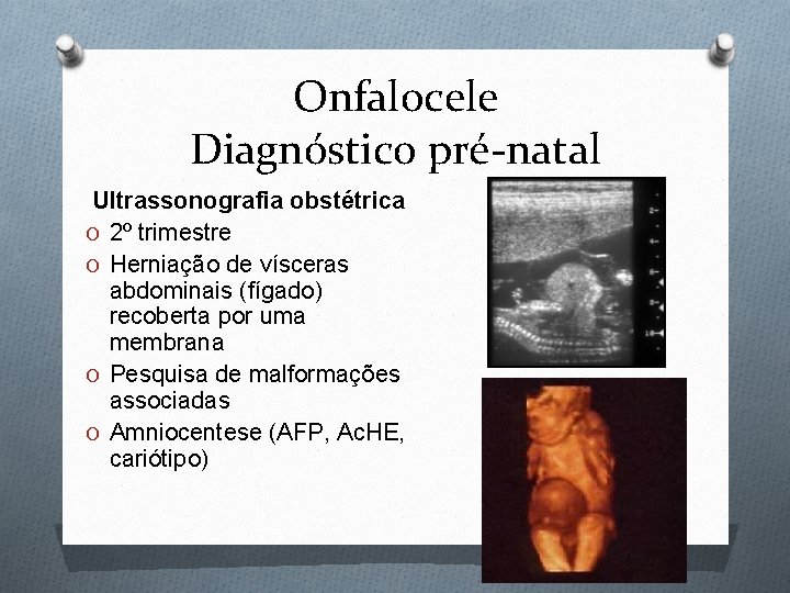 Onfalocele Diagnóstico pré-natal Ultrassonografia obstétrica O 2º trimestre O Herniação de vísceras abdominais (fígado)