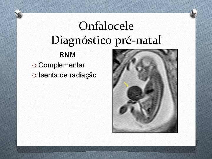 Onfalocele Diagnóstico pré-natal RNM O Complementar O Isenta de radiação 