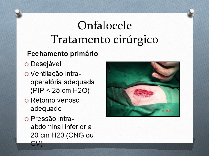 Onfalocele Tratamento cirúrgico Fechamento primário O Desejável O Ventilação intraoperatória adequada (PIP < 25