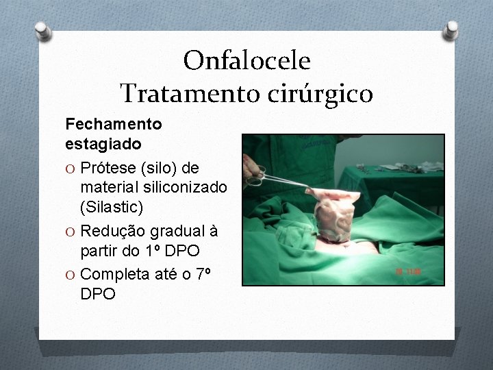 Onfalocele Tratamento cirúrgico Fechamento estagiado O Prótese (silo) de material siliconizado (Silastic) O Redução