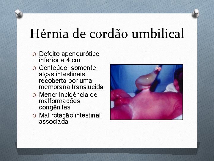 Hérnia de cordão umbilical O Defeito aponeurótico inferior a 4 cm O Conteúdo: somente