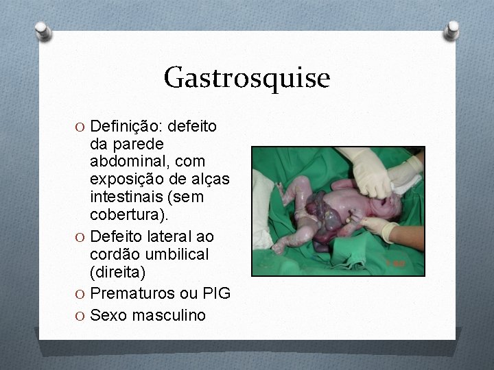 Gastrosquise O Definição: defeito da parede abdominal, com exposição de alças intestinais (sem cobertura).