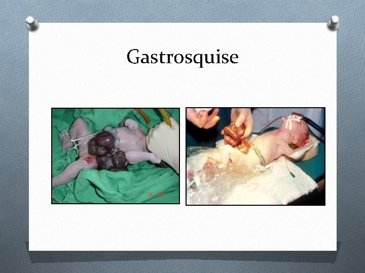 Gastrosquise 