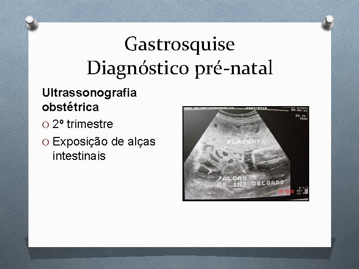 Gastrosquise Diagnóstico pré-natal Ultrassonografia obstétrica O 2º trimestre O Exposição de alças intestinais 