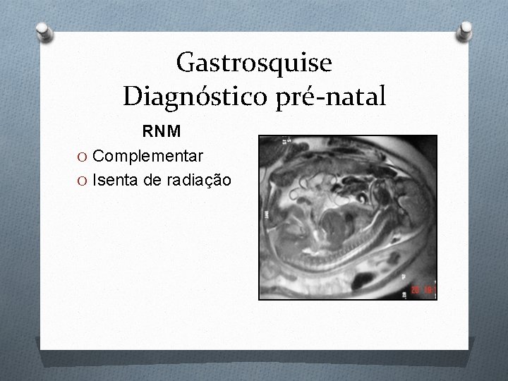 Gastrosquise Diagnóstico pré-natal RNM O Complementar O Isenta de radiação 