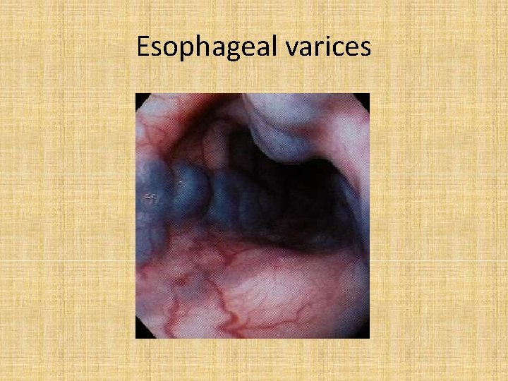 Esophageal varices 