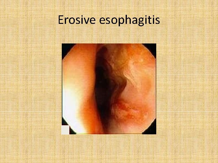 Erosive esophagitis 