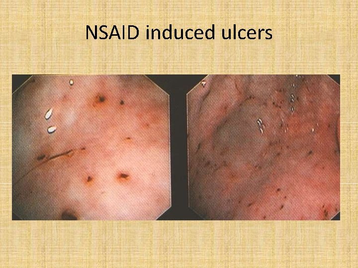 NSAID induced ulcers 
