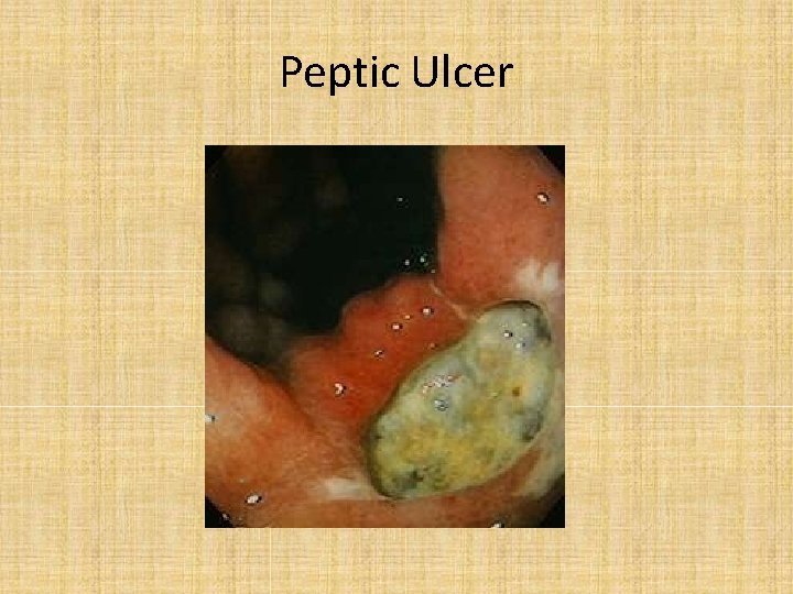 Peptic Ulcer 