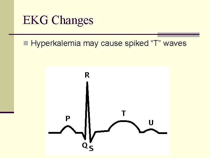 EKG Changes n Hyperkalemia may cause spiked “T” waves 
