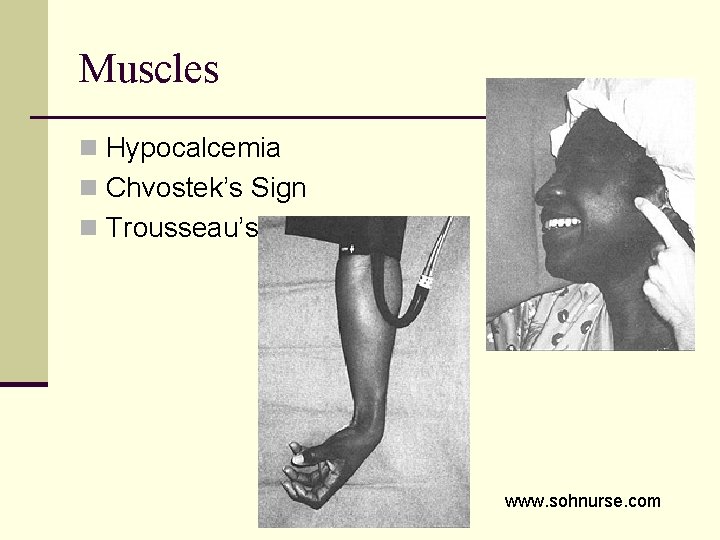Muscles n Hypocalcemia n Chvostek’s Sign n Trousseau’s www. sohnurse. com 