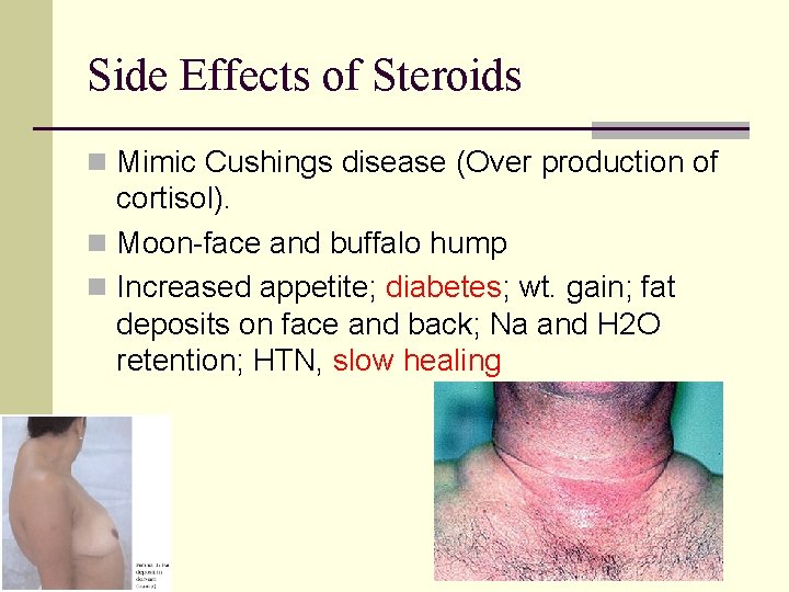 Side Effects of Steroids n Mimic Cushings disease (Over production of cortisol). n Moon-face