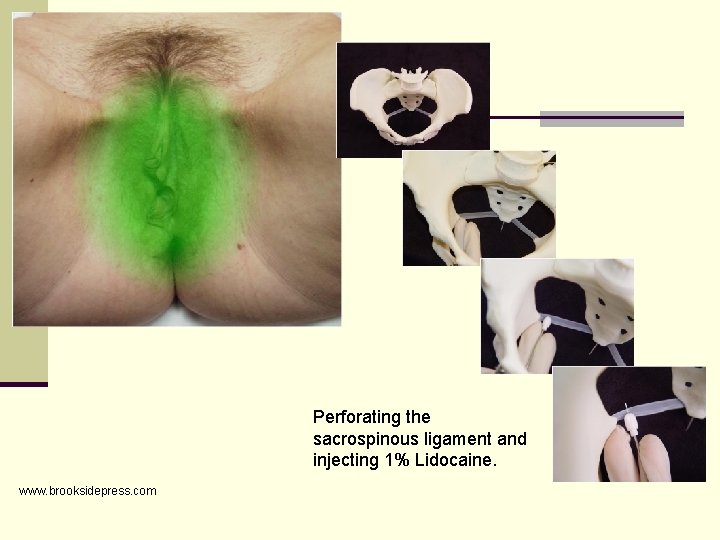 Perforating the sacrospinous ligament and injecting 1% Lidocaine. www. brooksidepress. com 