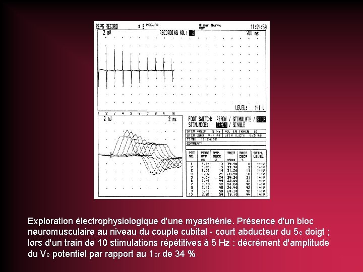 Exploration électrophysiologique d'une myasthénie. Présence d'un bloc neuromusculaire au niveau du couple cubital -