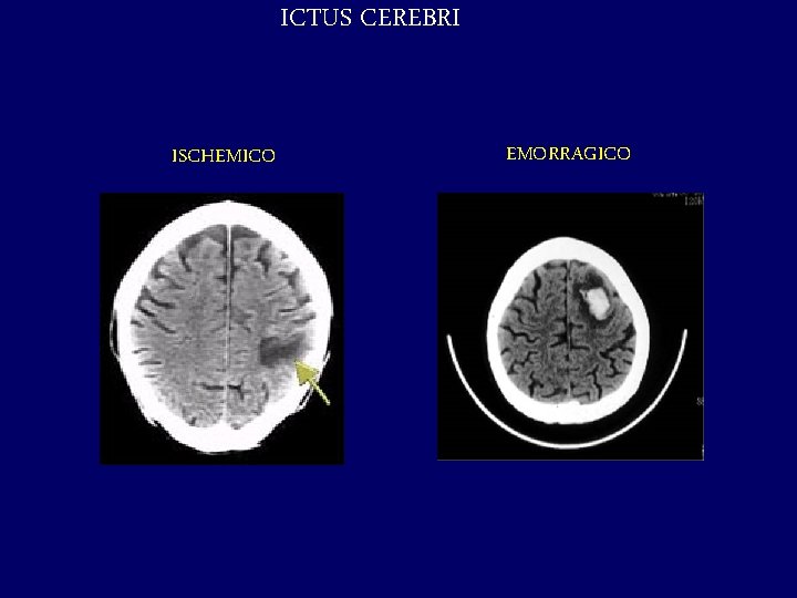 ICTUS CEREBRI ISCHEMICO EMORRAGICO 