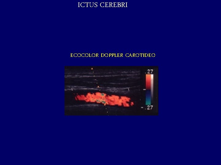 ICTUS CEREBRI ECOCOLOR DOPPLER CAROTIDEO 