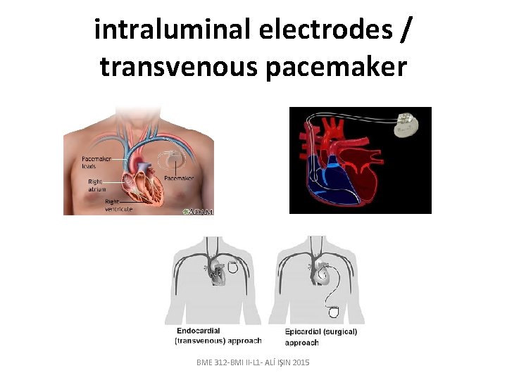 intraluminal electrodes / transvenous pacemaker BME 312 -BMI II-L 1 - ALİ IŞIN 2015