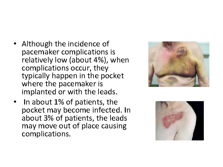  • Although the incidence of pacemaker complications is relatively low (about 4%), when