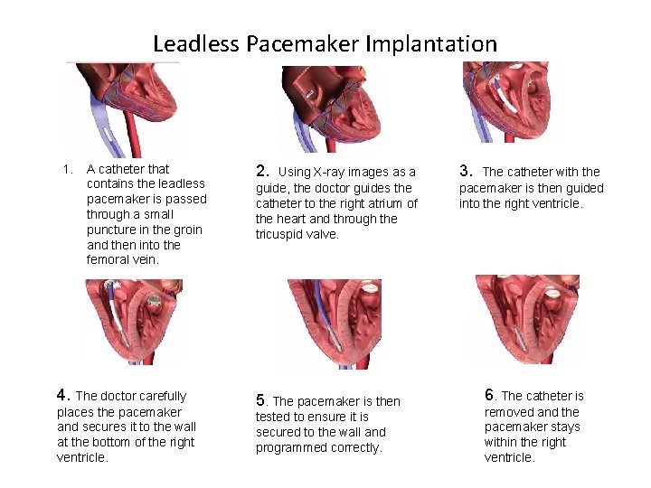 Leadless Pacemaker Implantation 1. A catheter that contains the leadless pacemaker is passed through