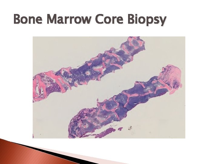 Bone Marrow Core Biopsy 
