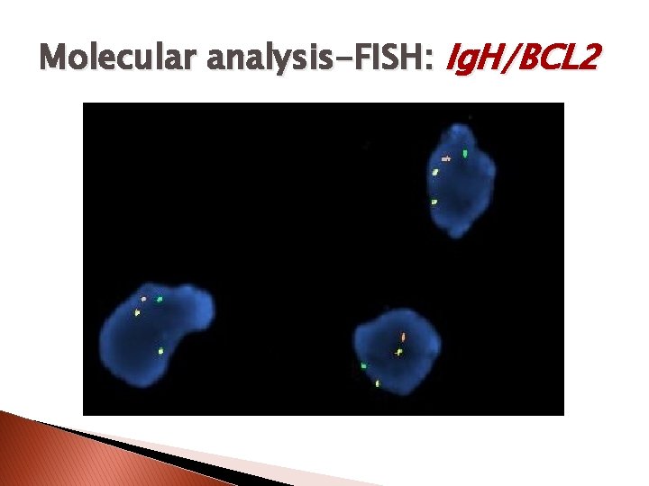 Molecular analysis-FISH: Ig. H/BCL 2 