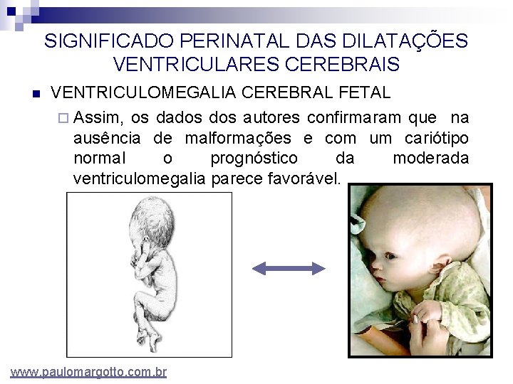 SIGNIFICADO PERINATAL DAS DILATAÇÕES VENTRICULARES CEREBRAIS n VENTRICULOMEGALIA CEREBRAL FETAL ¨ Assim, os dados