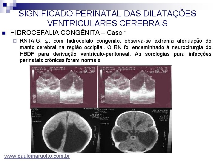 SIGNIFICADO PERINATAL DAS DILATAÇÕES VENTRICULARES CEREBRAIS n HIDROCEFALIA CONGÊNITA – Caso 1 ¨ RNTAIG,