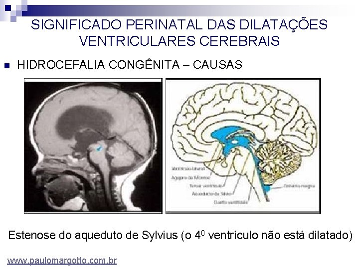 SIGNIFICADO PERINATAL DAS DILATAÇÕES VENTRICULARES CEREBRAIS n HIDROCEFALIA CONGÊNITA – CAUSAS Estenose do aqueduto