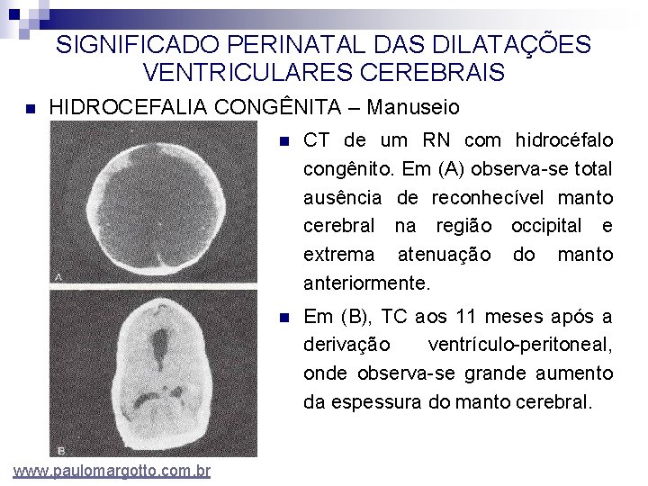 SIGNIFICADO PERINATAL DAS DILATAÇÕES VENTRICULARES CEREBRAIS n HIDROCEFALIA CONGÊNITA – Manuseio www. paulomargotto. com.