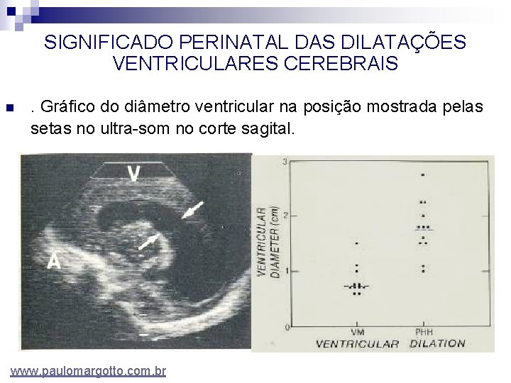 SIGNIFICADO PERINATAL DAS DILATAÇÕES VENTRICULARES CEREBRAIS n . Gráfico do diâmetro ventricular na posição