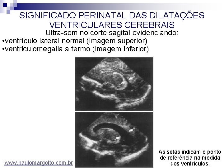 SIGNIFICADO PERINATAL DAS DILATAÇÕES VENTRICULARES CEREBRAIS Ultra-som no corte sagital evidenciando: • ventrículo lateral