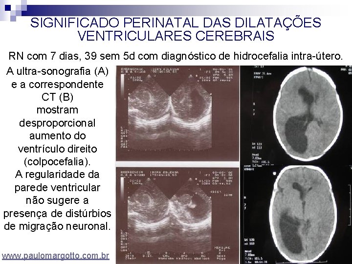 SIGNIFICADO PERINATAL DAS DILATAÇÕES VENTRICULARES CEREBRAIS RN com 7 dias, 39 sem 5 d