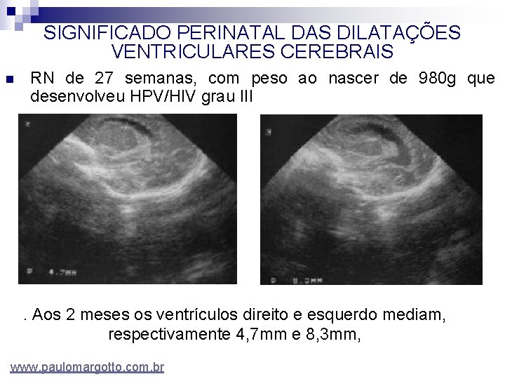 SIGNIFICADO PERINATAL DAS DILATAÇÕES VENTRICULARES CEREBRAIS n RN de 27 semanas, com peso ao