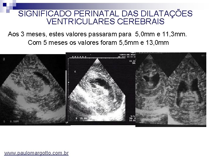 SIGNIFICADO PERINATAL DAS DILATAÇÕES VENTRICULARES CEREBRAIS Aos 3 meses, estes valores passaram para 5,