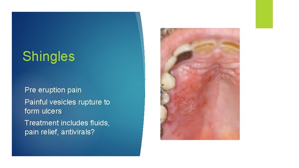 Shingles Pre eruption pain Painful vesicles rupture to form ulcers Treatment includes fluids, pain