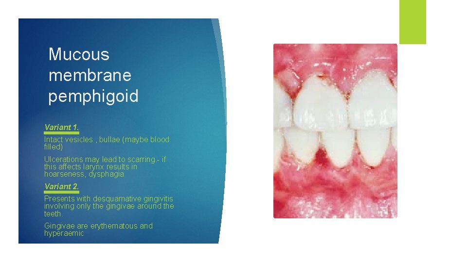 Mucous membrane pemphigoid Variant 1. Intact vesicles , bullae (maybe blood filled) Ulcerations may