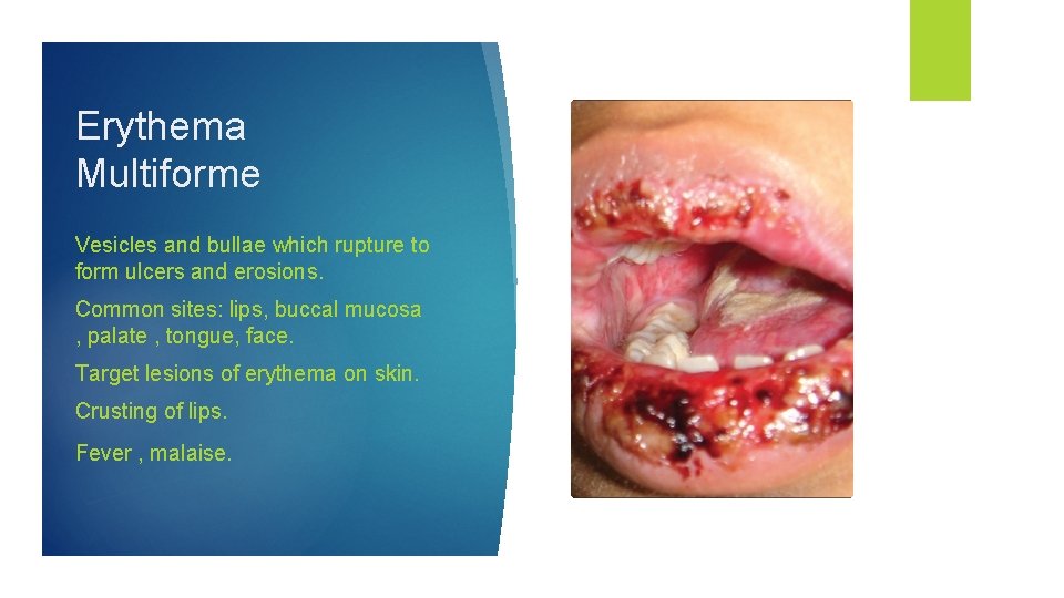 Erythema Multiforme Vesicles and bullae which rupture to form ulcers and erosions. Common sites: