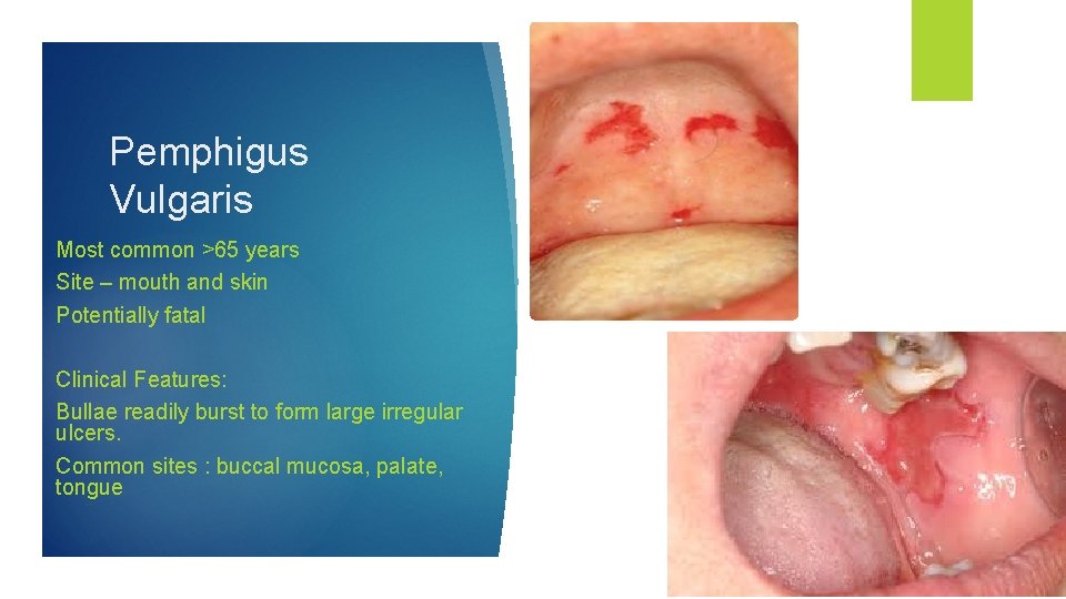 Pemphigus Vulgaris Most common >65 years Site – mouth and skin Potentially fatal Clinical