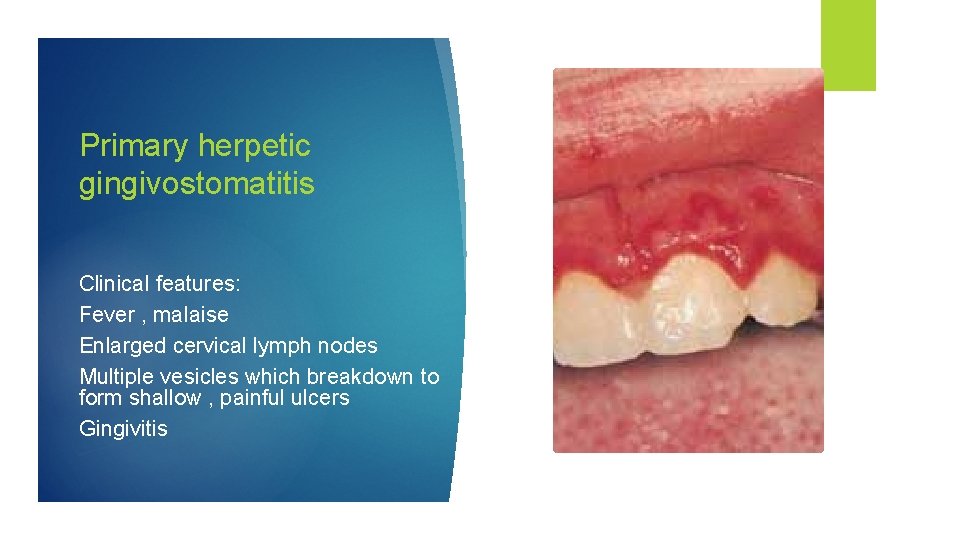 Primary herpetic gingivostomatitis Clinical features: Fever , malaise Enlarged cervical lymph nodes Multiple vesicles