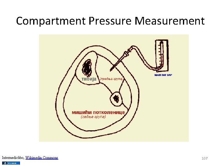 Compartment Pressure Measurement Intermedichbo, Wikimedia Commons 107 